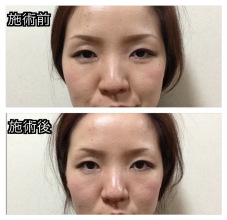 施術前後 美容鍼の前後