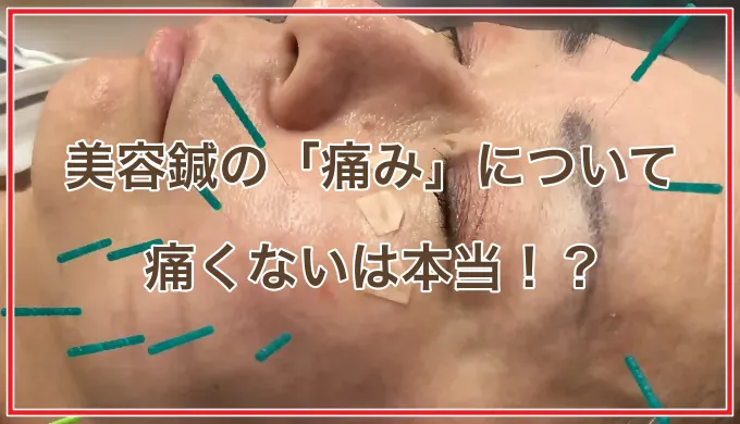 美容鍼は痛くない