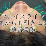 頭皮美鍼でリフトアップ