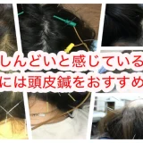 頭皮鍼をおすすめします