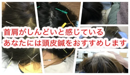 頭皮鍼をおすすめします