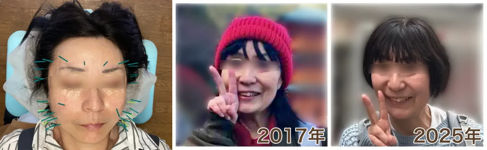 美容鍼を受けている女性の経過