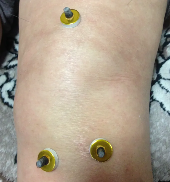 膝にお灸をしているところ