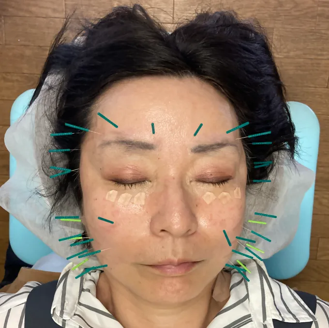 美容鍼を受けている女性