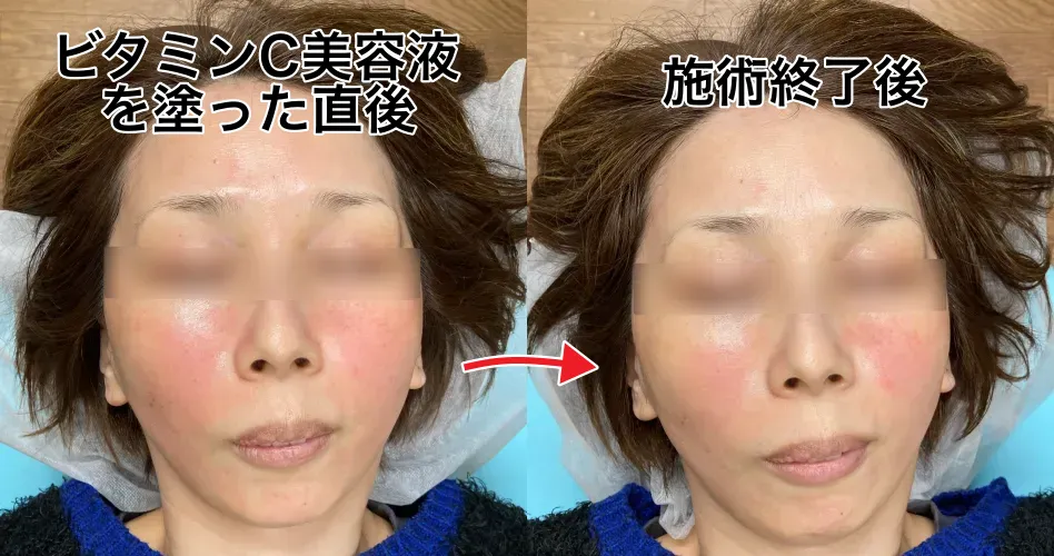 ビタミンC美容液塗った後と施術終了後