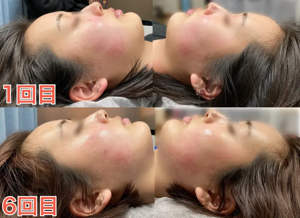 10代K様1回目と6回目（左右）