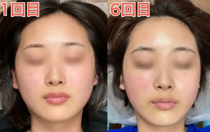 10代K様1回目と6回目（正面）