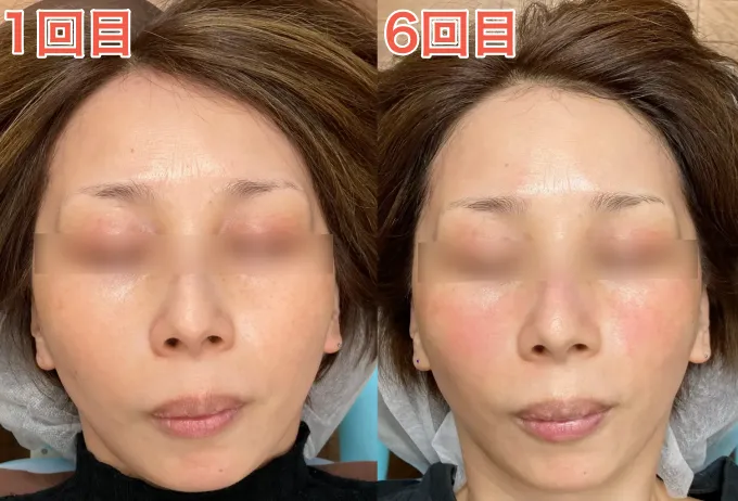 40代Y様1回目と6回目（正面）