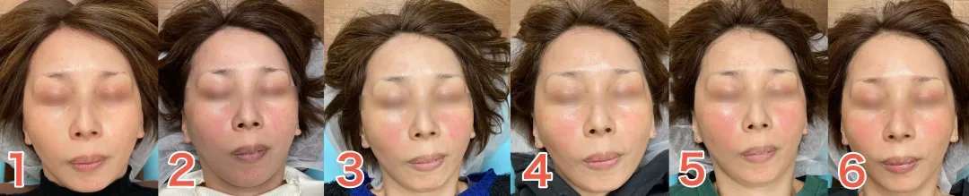 40代Y様1回目から6回目