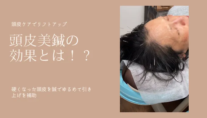 頭皮ケアでリフトアップ、頭皮美鍼