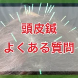 頭皮鍼のよくある質問