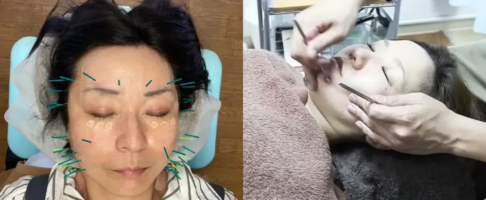 美容鍼と刺さない美容鍼