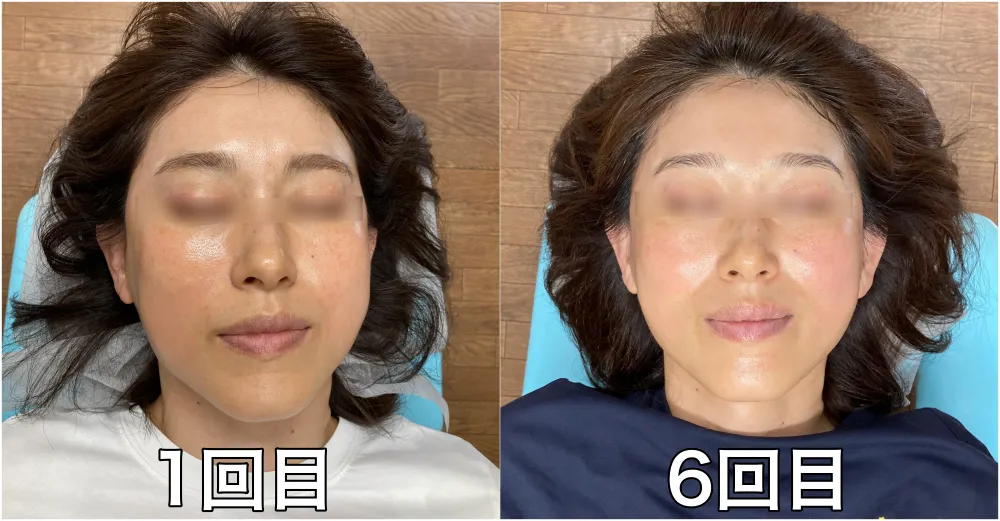 40代M様1回目と6回目（正面）