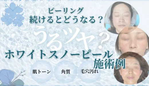 ピーリング続けるとどうなる！？ホワイトスノーピールの施術例