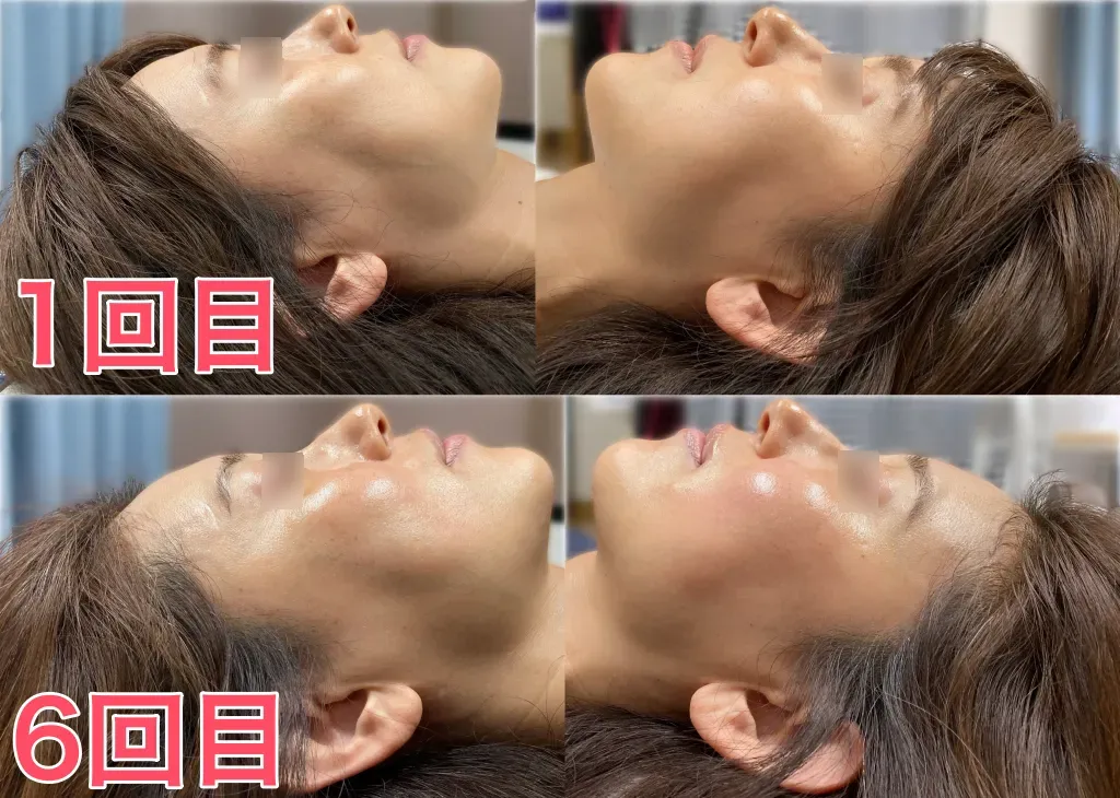 40代M様1回目と6回目（左右）