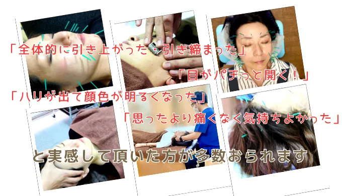美容鍼を受けてみて実感