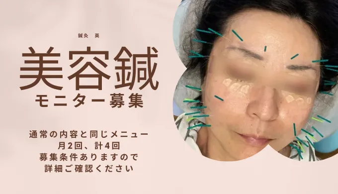 美容鍼のモニター募集