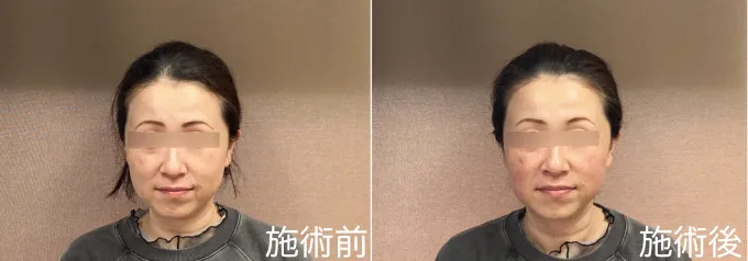 美容鍼の施術前、施術後