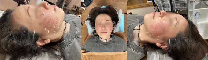 美容鍼施術中の様子