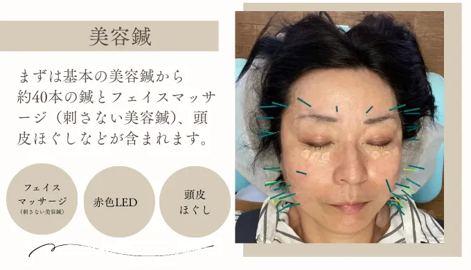 40本の鍼を使った美容鍼