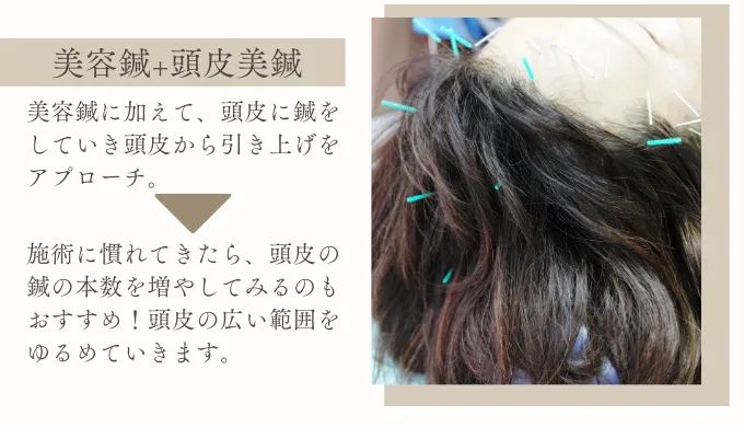 頭皮の鍼でアプローチ、頭皮美鍼