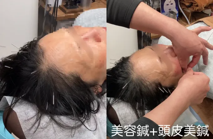 美容鍼と頭皮美鍼を受ける女性