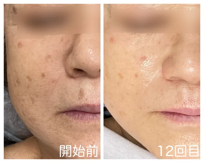 12回目を終えた肌の様子