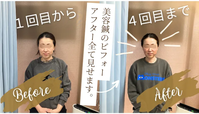 美容鍼4回の比較
