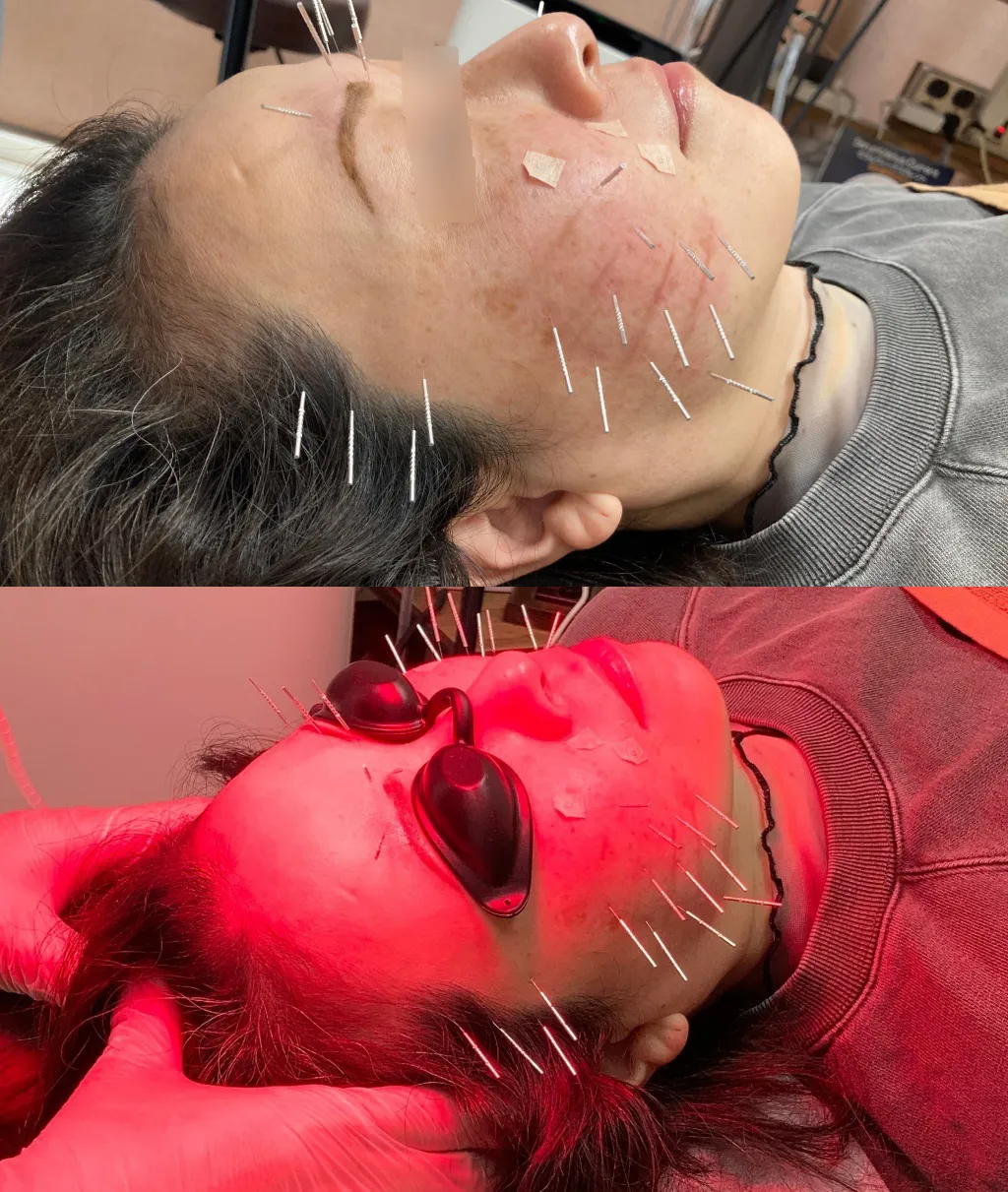 美容鍼1回目、赤色LEDと頭皮ほぐし