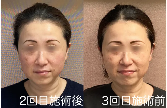 2回目施術後と3回目施術前