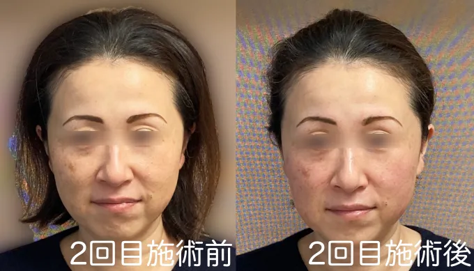 2回目の施術の前後