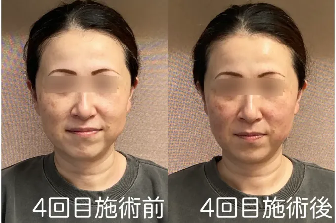 4回目美容鍼施術の前後