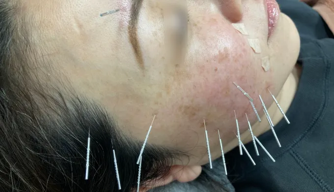 美容鍼を受けている女性