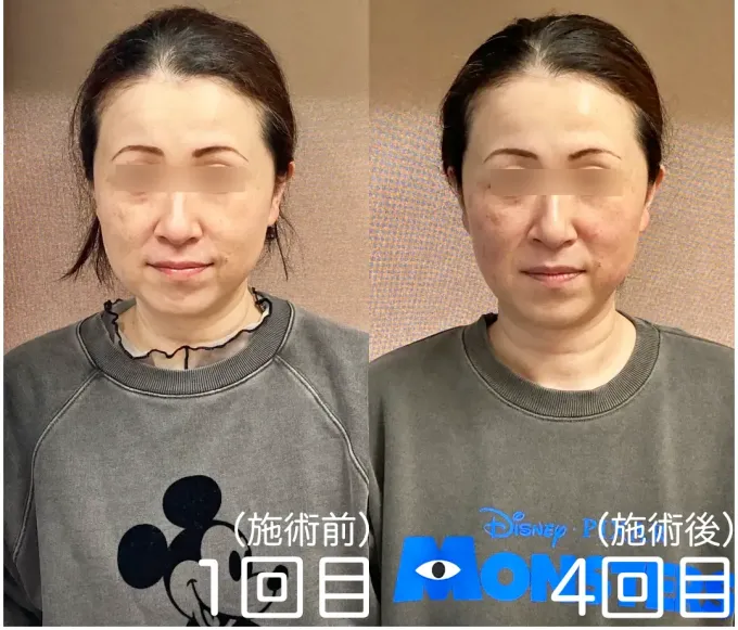 美容鍼1回目施術前と4回目施術後