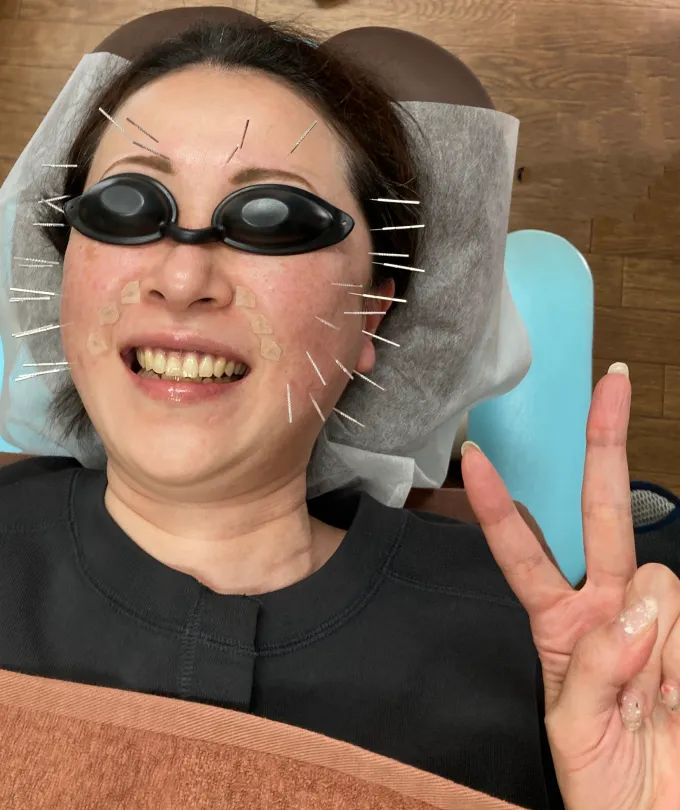 美容鍼にもかなり慣れた様子