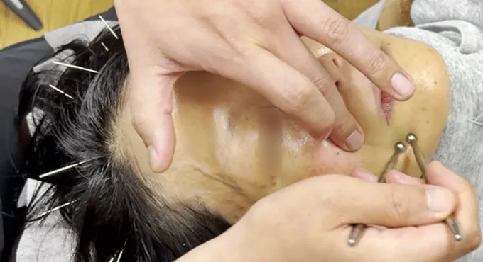 刺さない美容鍼を受けている女性の様子