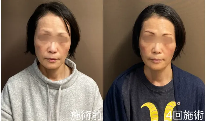 美容鍼+頭皮美鍼4回施術