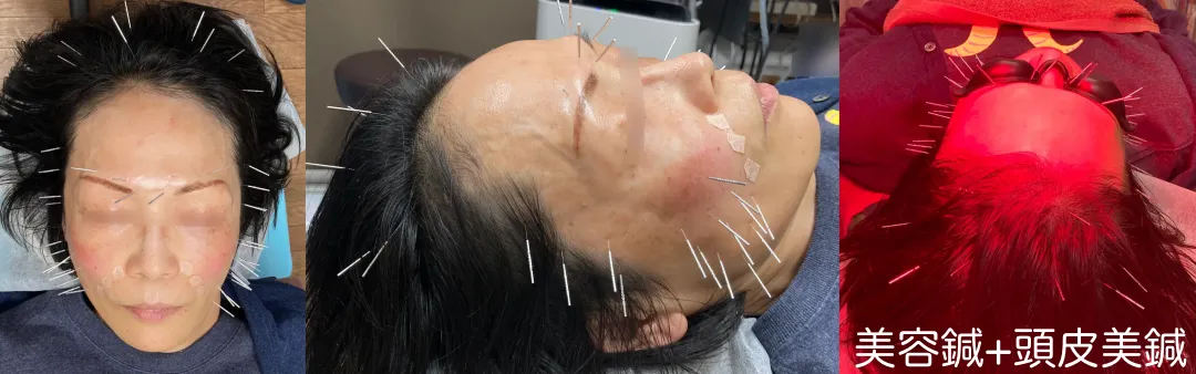 美容鍼+頭皮美鍼と赤色LED