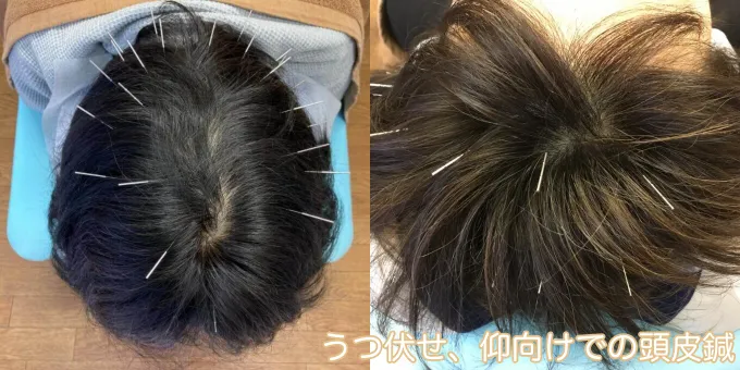 うつ伏せ、仰向けでの頭皮鍼
