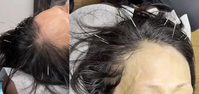 頭皮美鍼、頭皮に鍼が刺さった状態