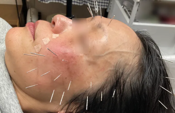 美容鍼を受けている女性