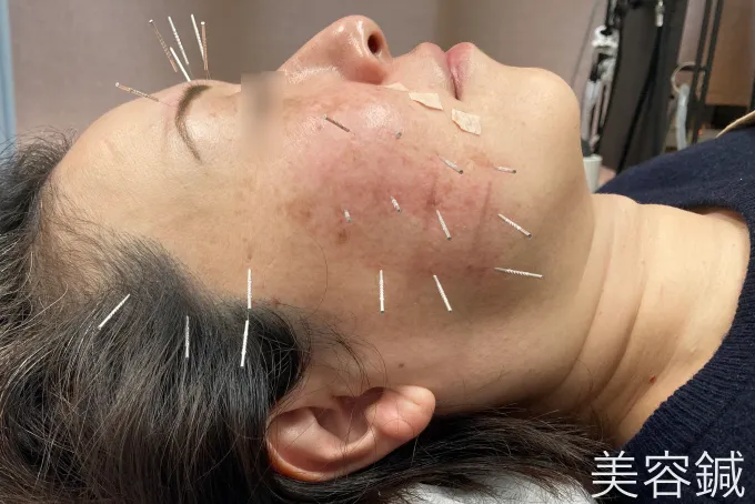 美容鍼を受けている女性