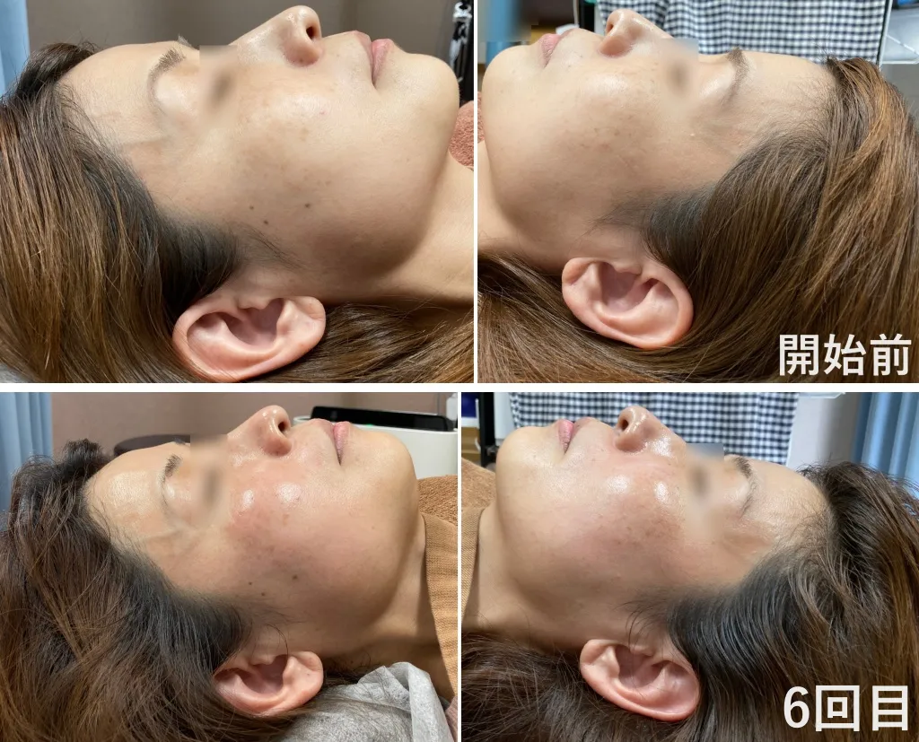 U様開始前と6回目（左右）