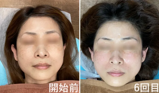 U様開始前と6回目の様子