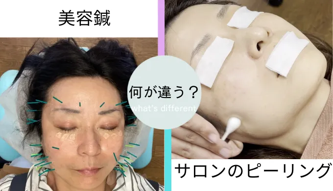 美容鍼とピーリングの違い