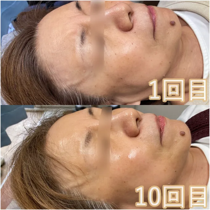 ララピール10回受けた感じ右