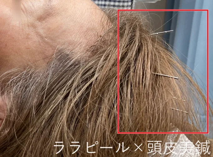 ララピールと頭皮美鍼の組み合わせ