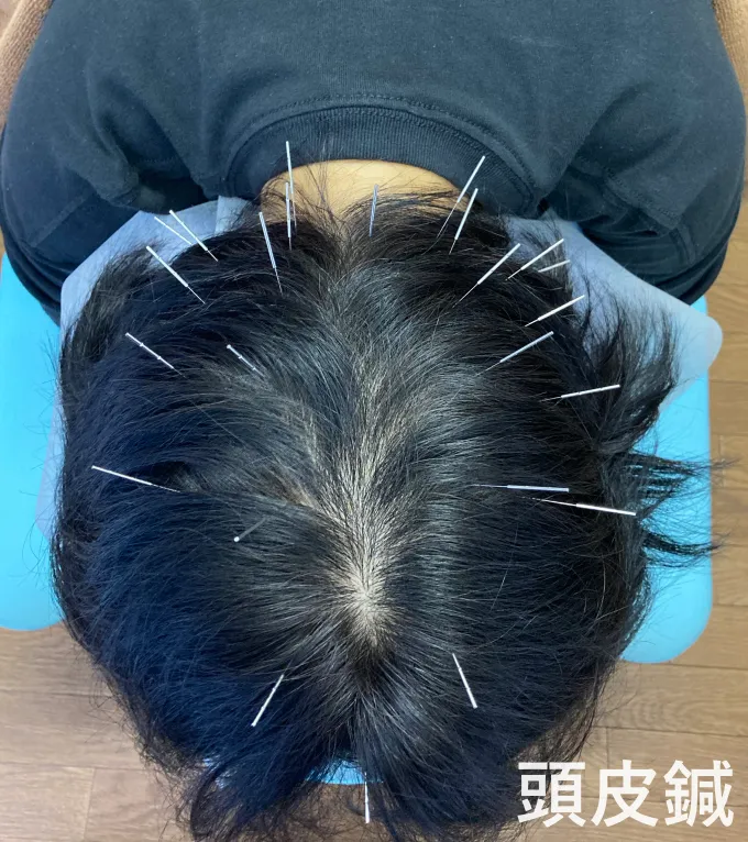 頭皮鍼を受けている様子