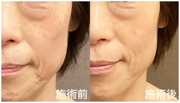 美容鍼4回の目の下、口元