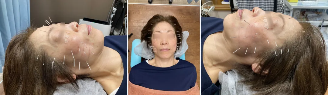 美容鍼を受けている女性、左右と正面